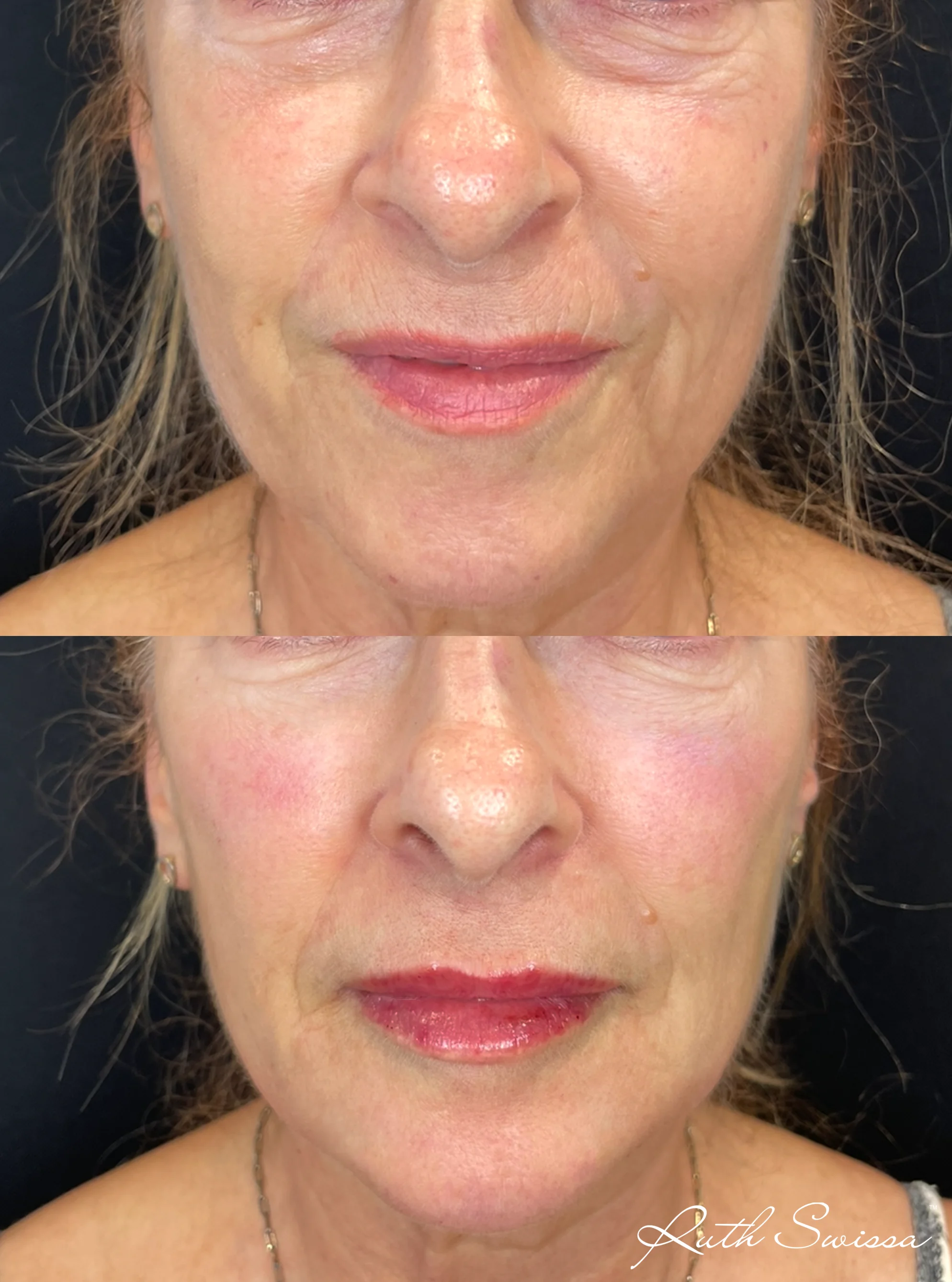 Facial balancing