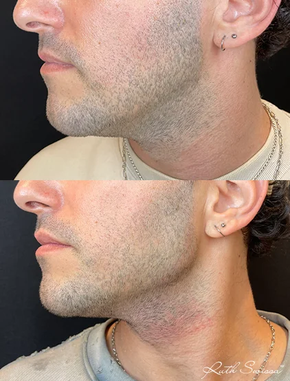 Jawline filler