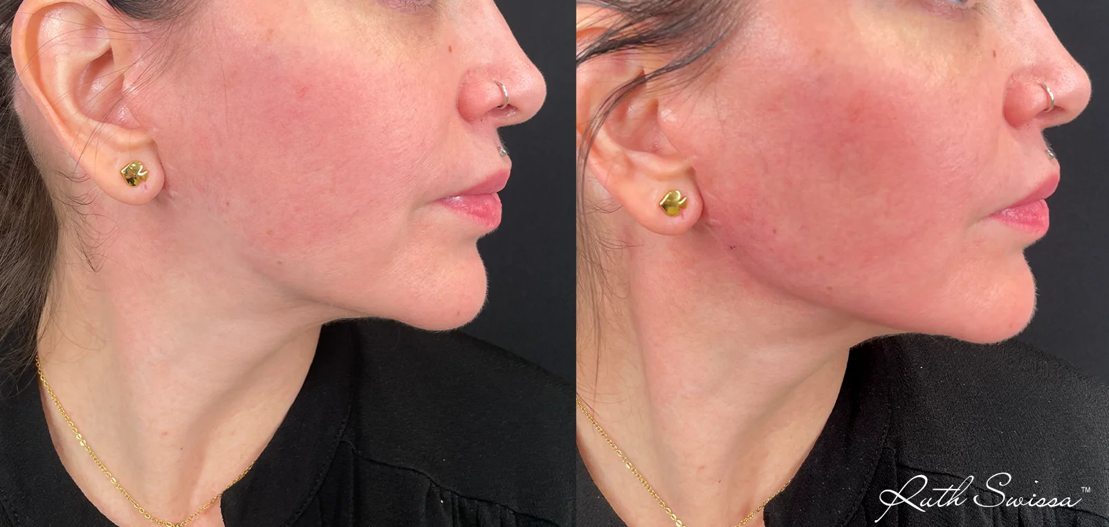 Jawline filler