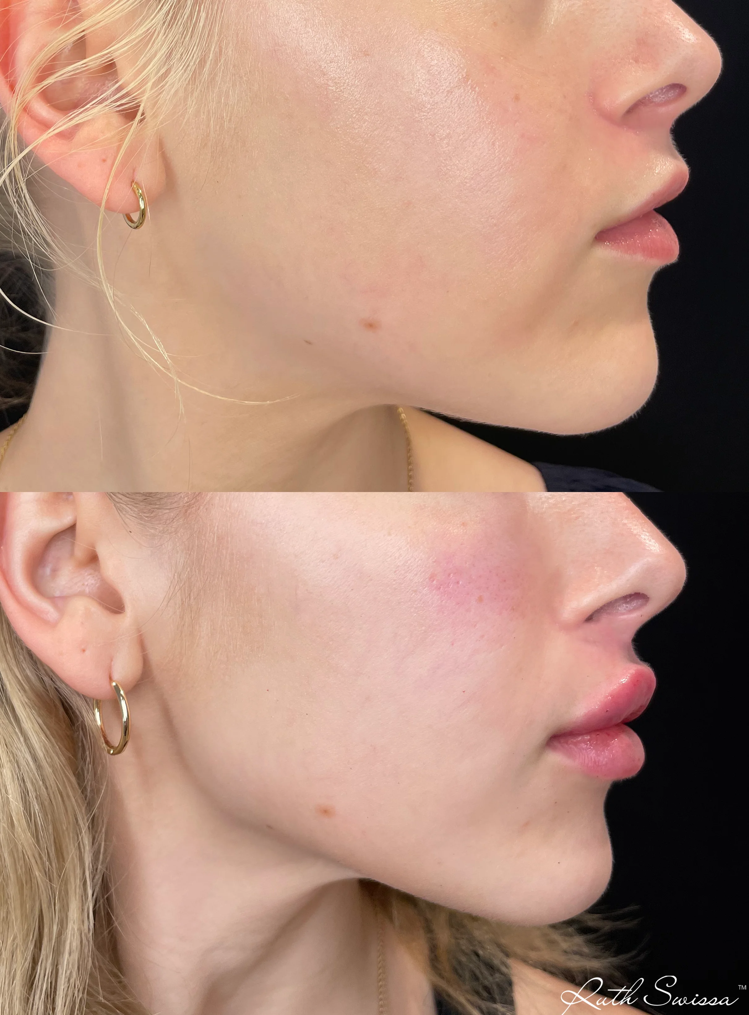 Jawline filler