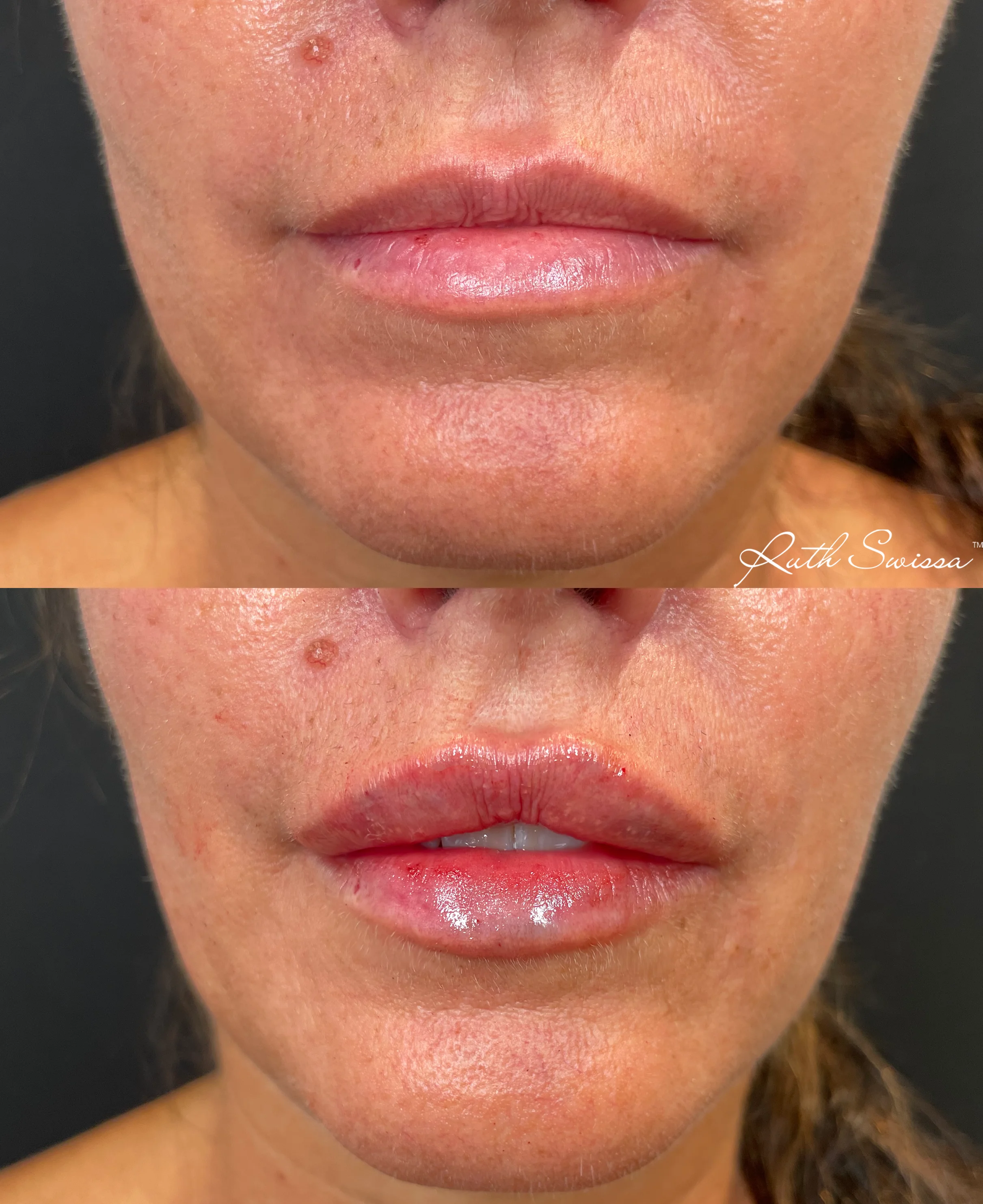 Lip filler