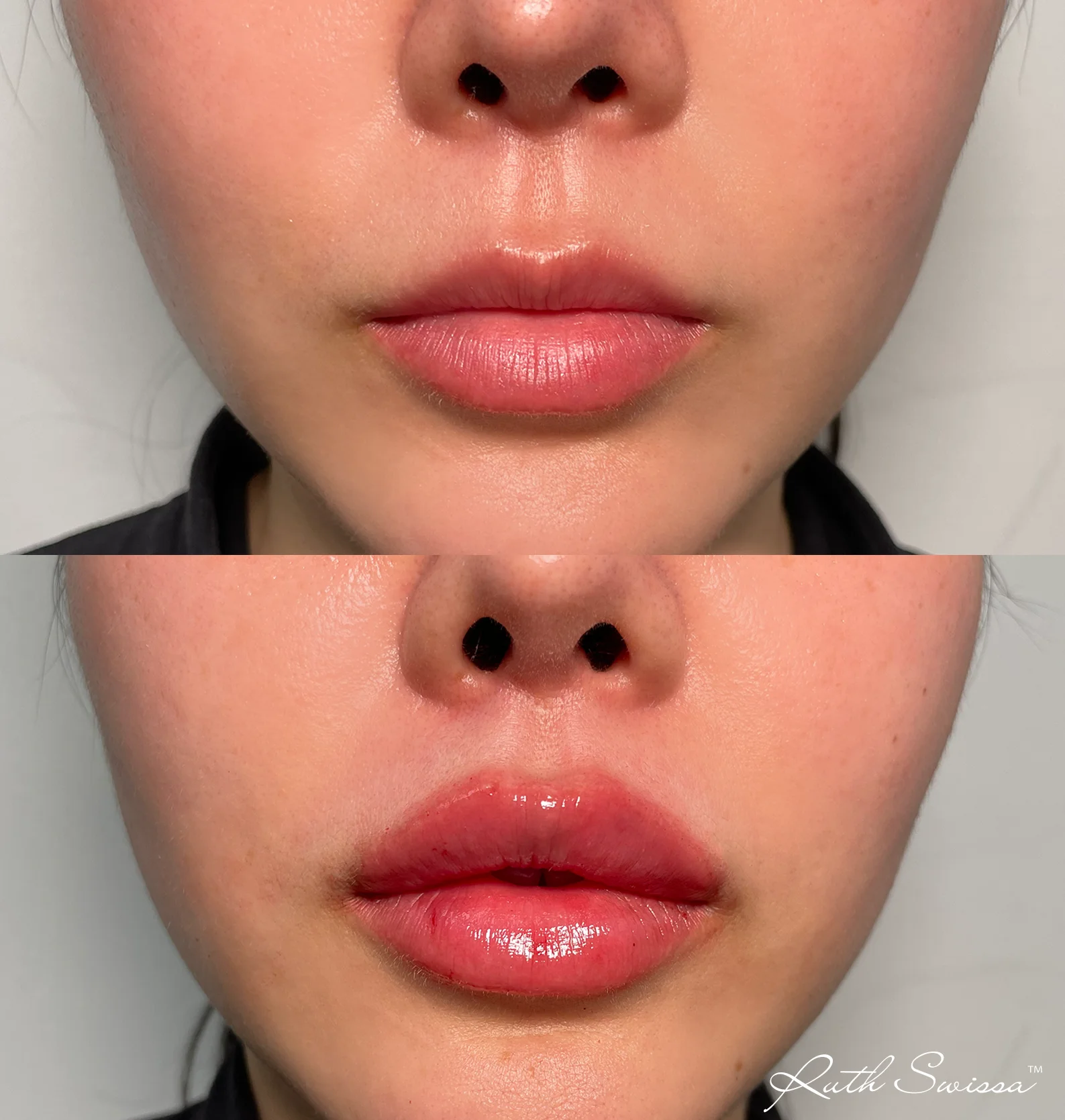 Lip filler