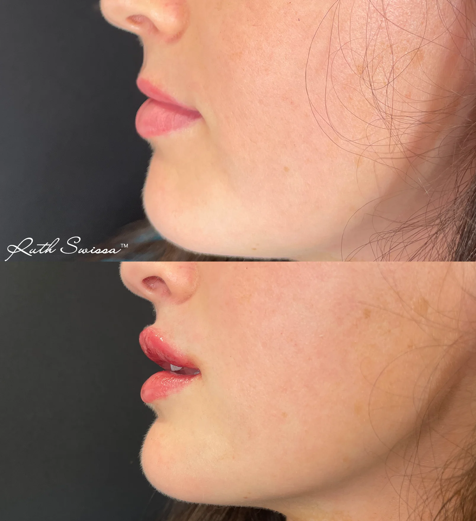 Lip filler