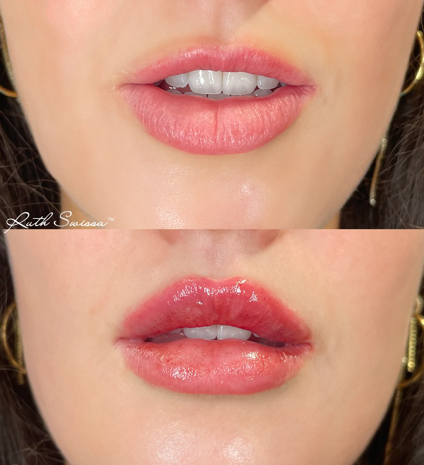 Lip filler