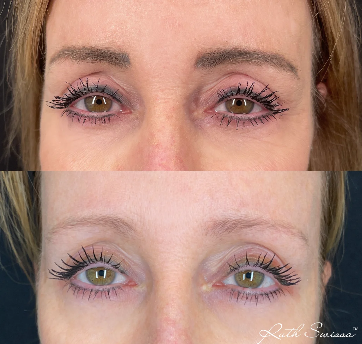 PMU laser removal