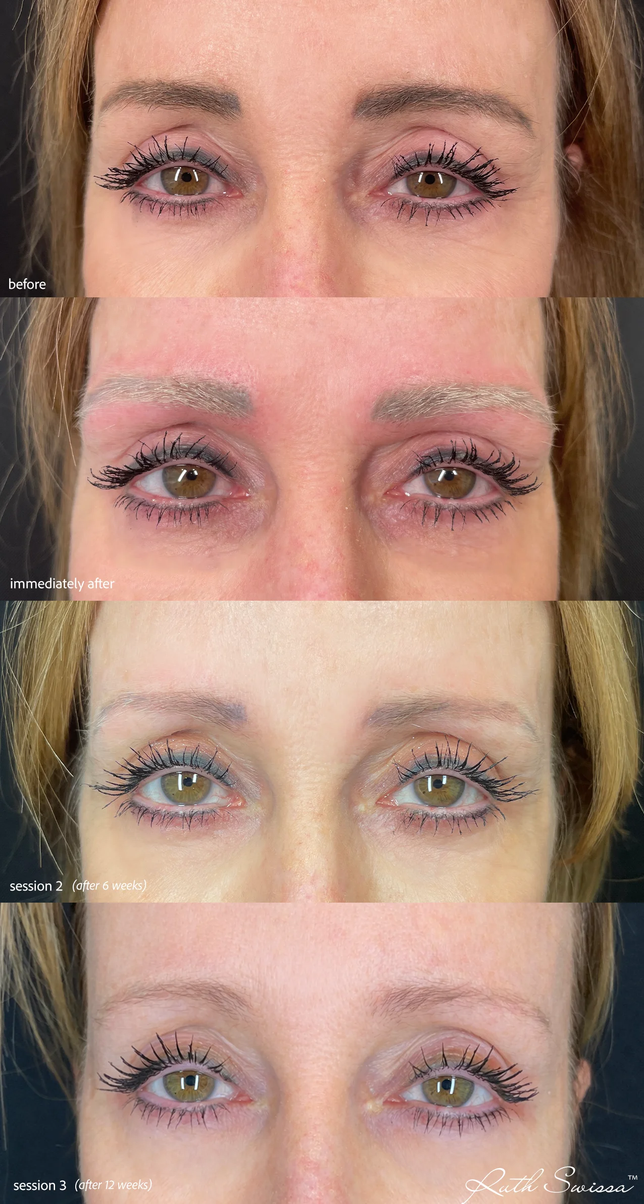 PMU laser removal