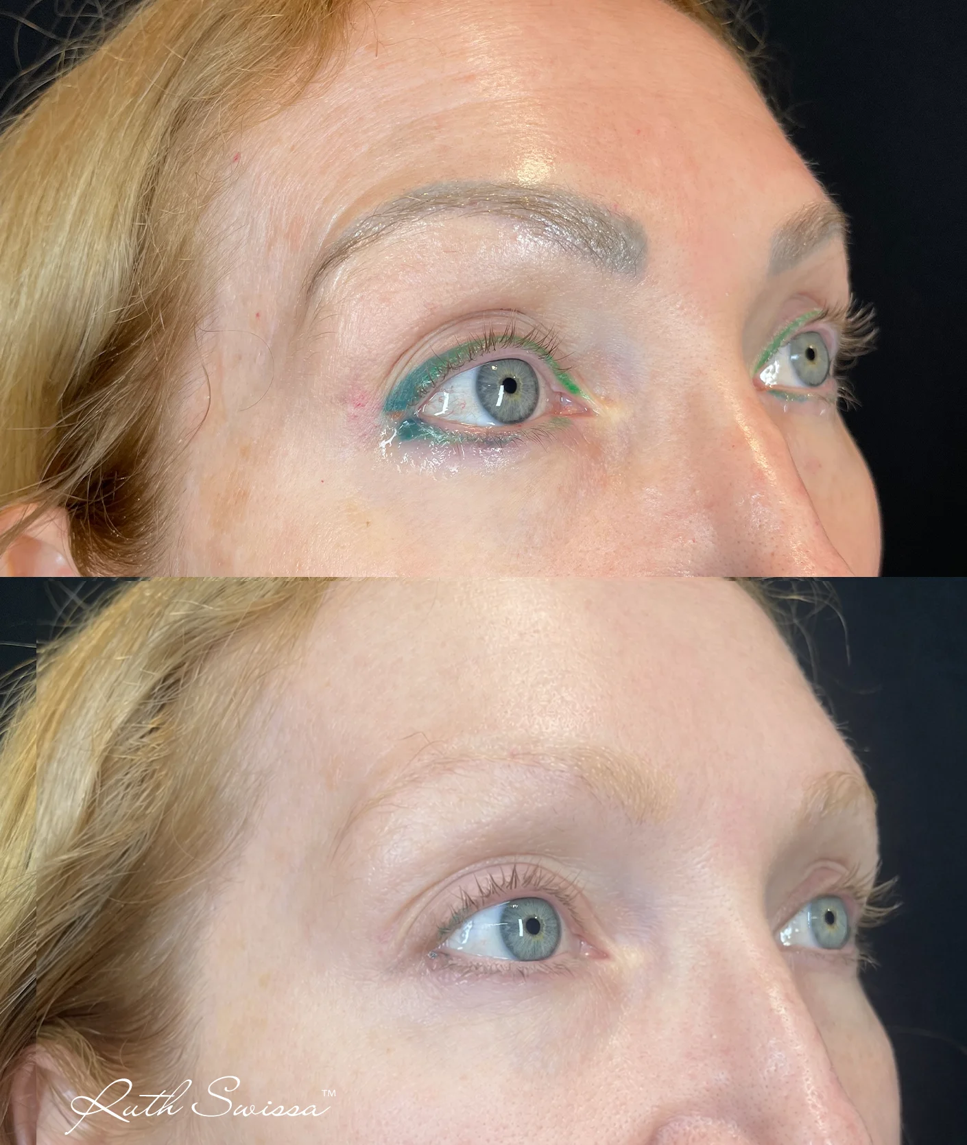 PMU laser removal