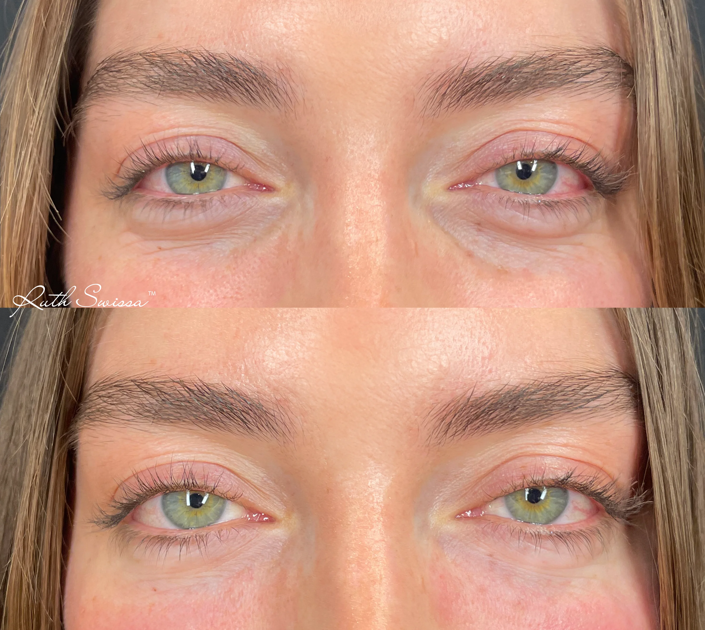 PRF undereye