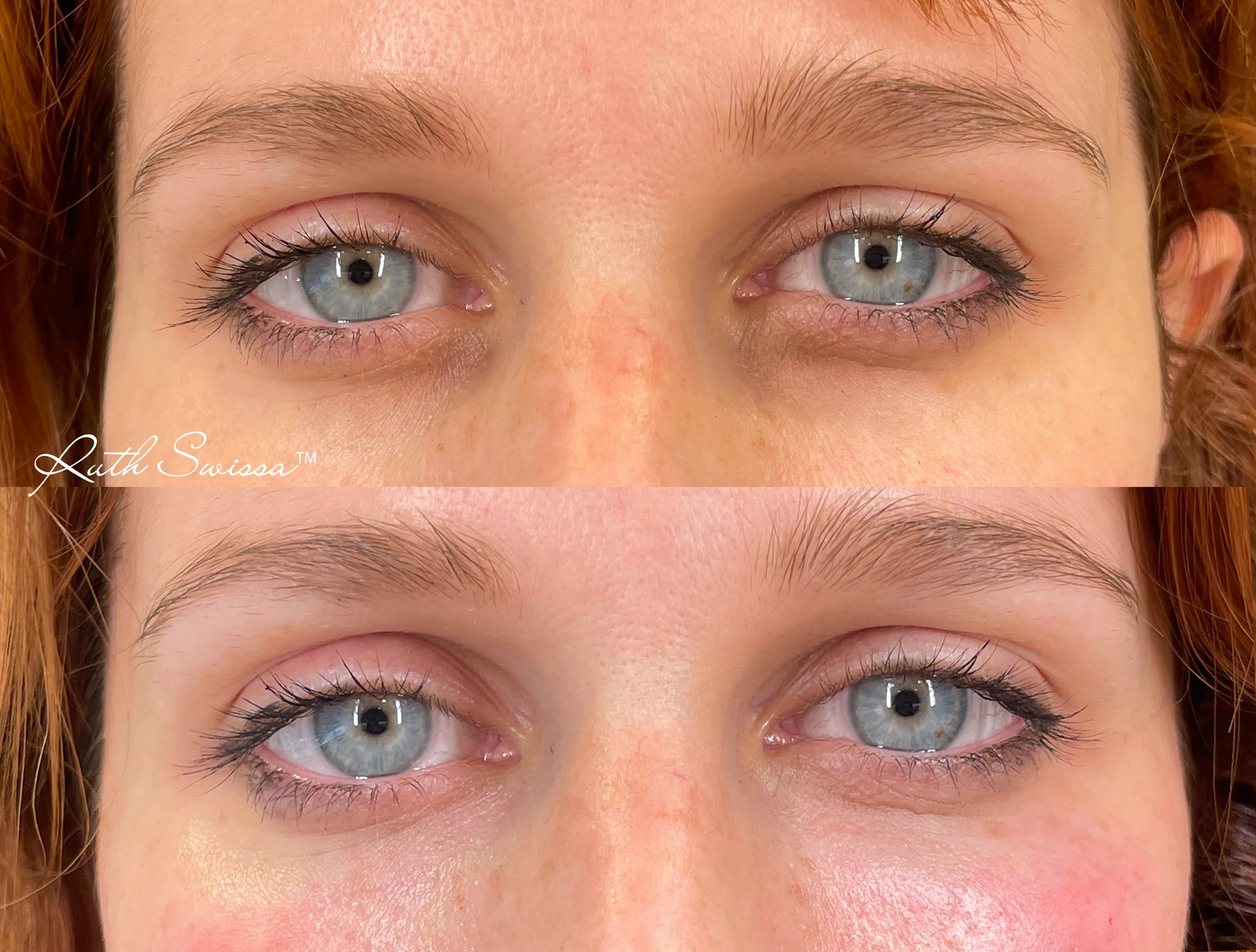 PRF undereye