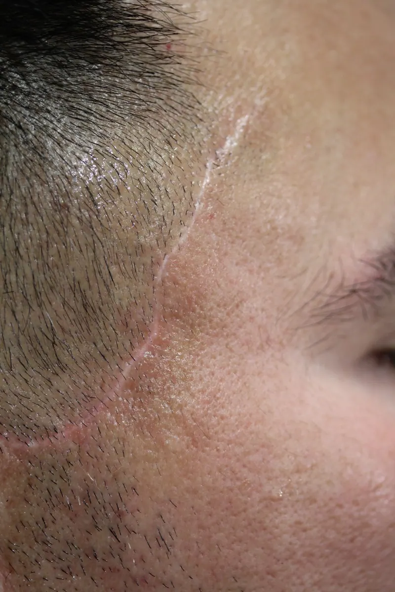 Before · mature scar in silvery-white stage
