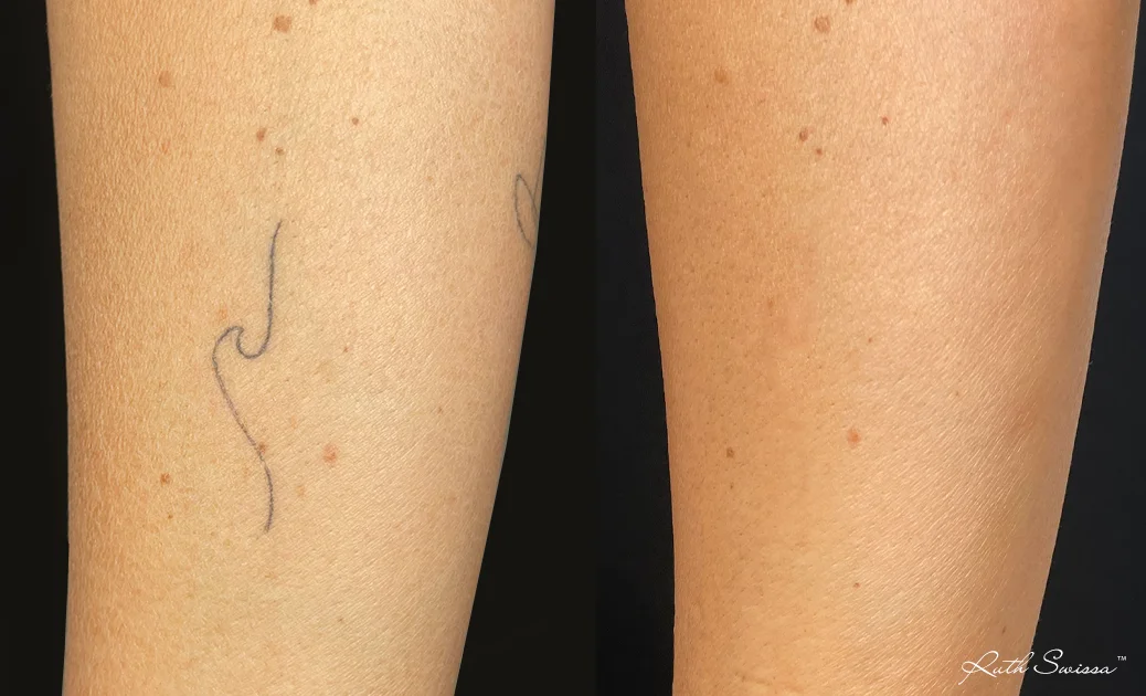 PicoSure