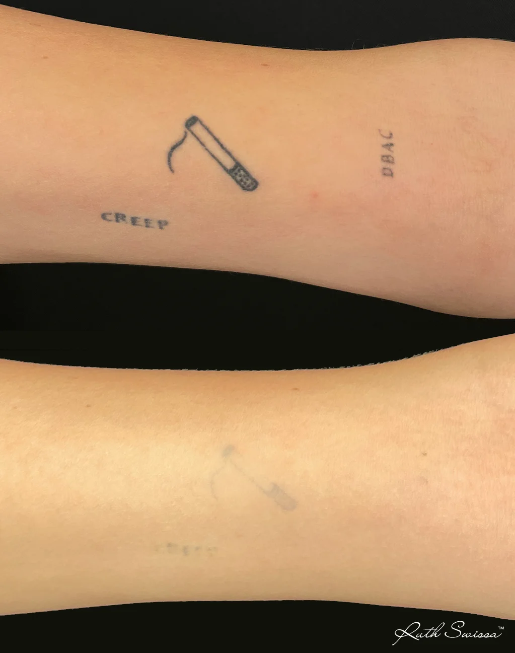PicoSure