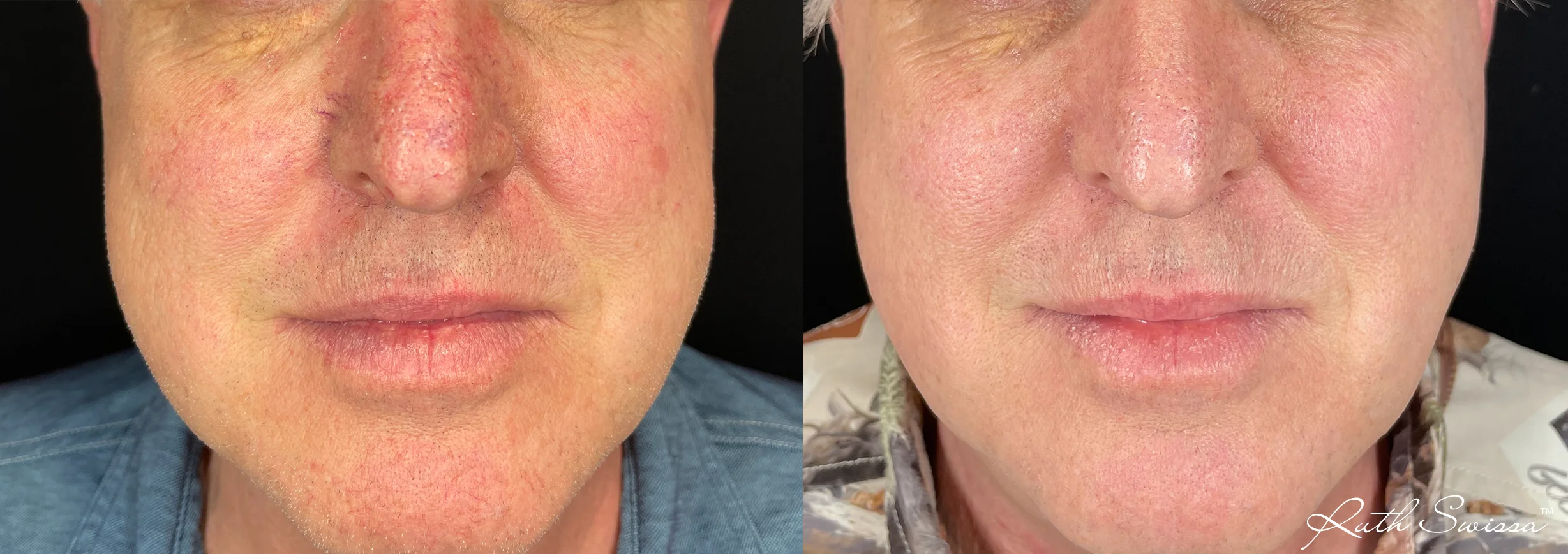 Vascular laser