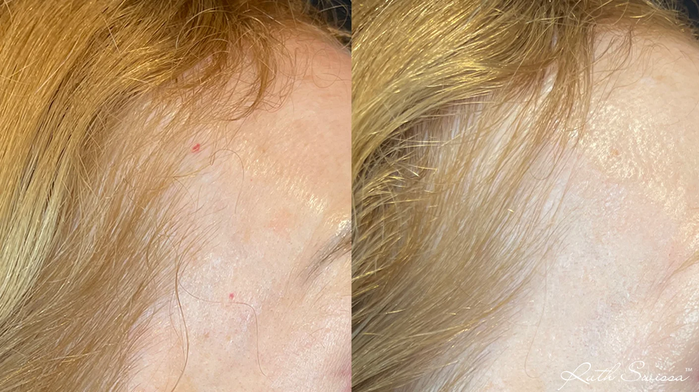 Vascular laser
