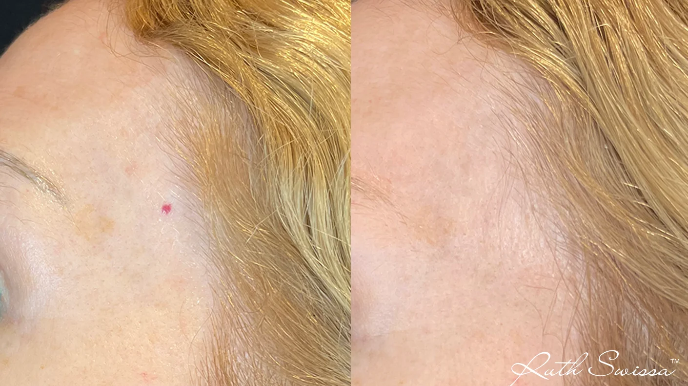 Vascular laser