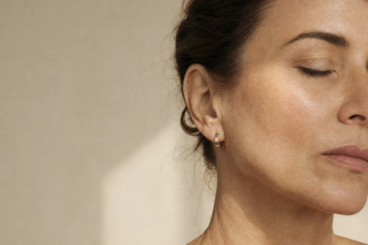 Cheek filler. Midface volume, placed on bone