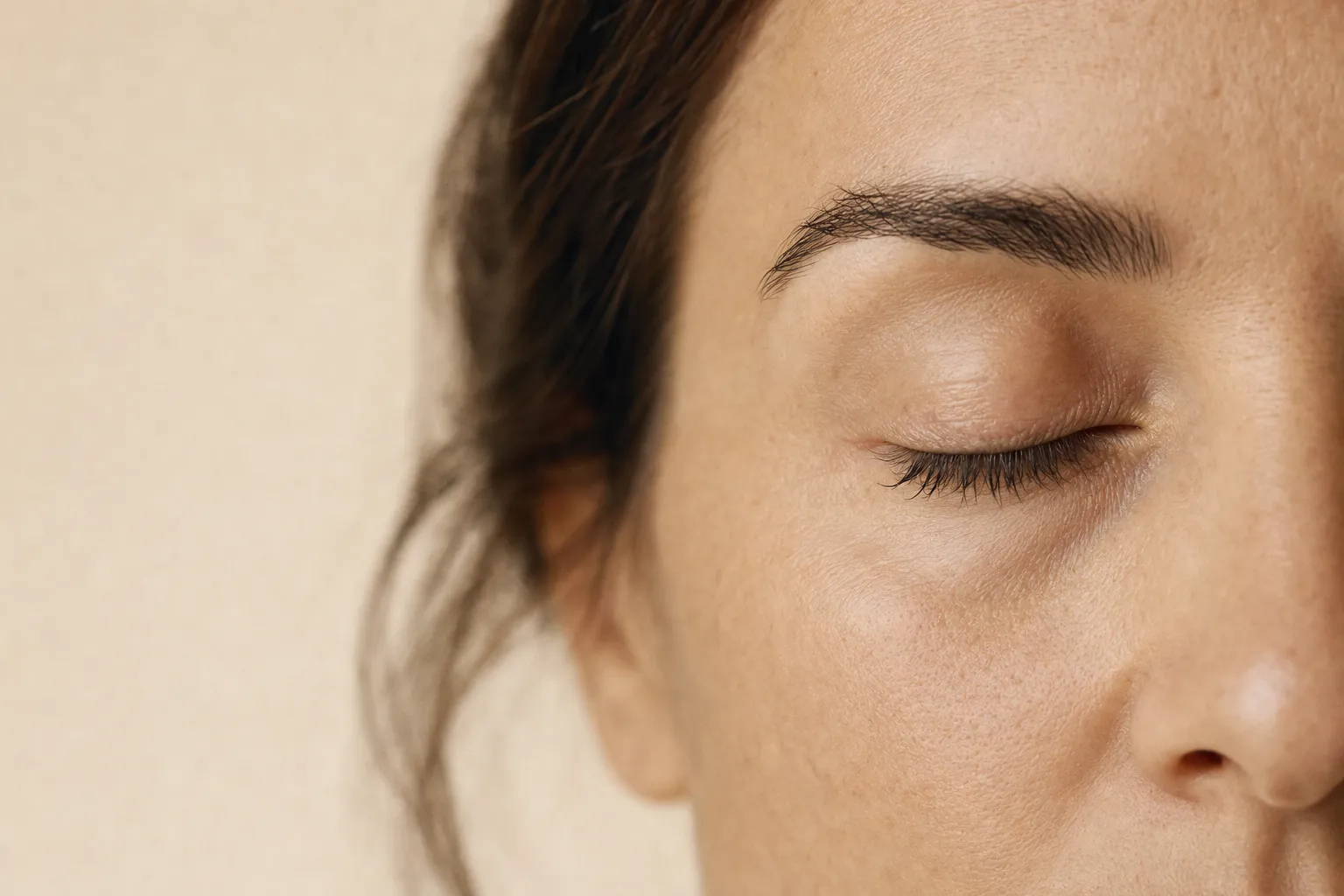 Under-eye filler. Tear trough treatment, done conservatively